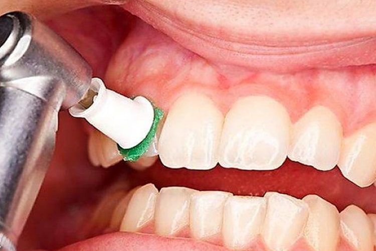 برند های مختلف تولید کننده جرمگیر دندانپزشکی